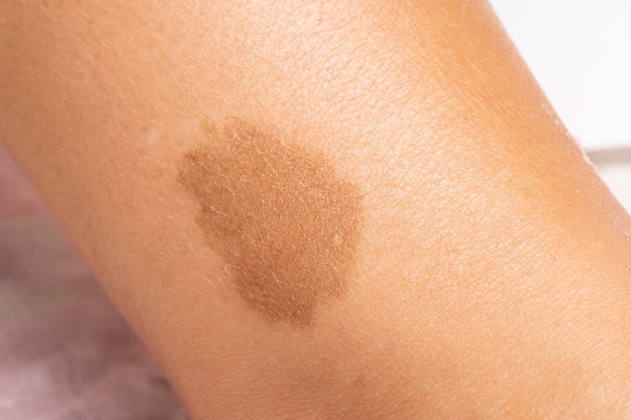 Can You Tattoo Over a Birthmark?